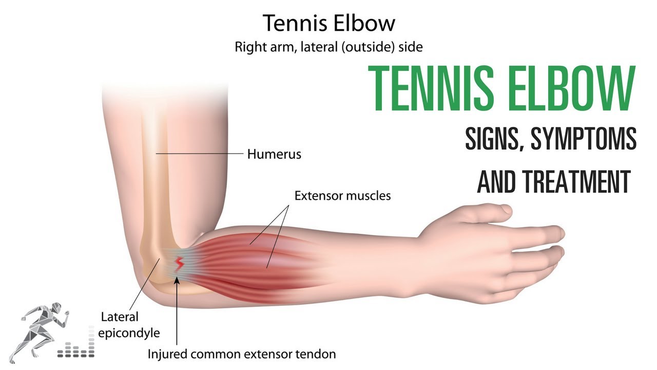 Tennis Elbow Injury Credits Dr David Geier